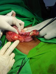 Surgeon with surgical instruments.