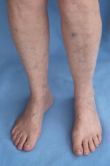 Varicose veins on old female legs. Phlebology,