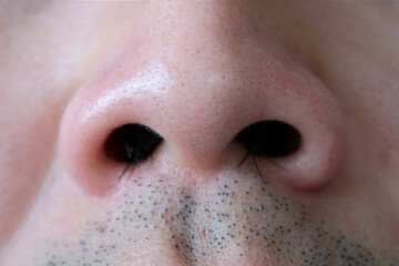 Fototapeta premium Young man's nose His nostrils are hairy. . Health and medical concepts