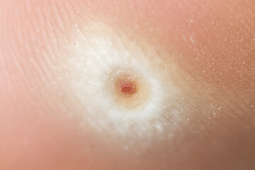 Fototapeta premium Plantar wart up close macro view. Small hard thickened callus around wart head on heel of foot. Verruca Plantaris solitary wart, after some topical treatments to reveal wart head.