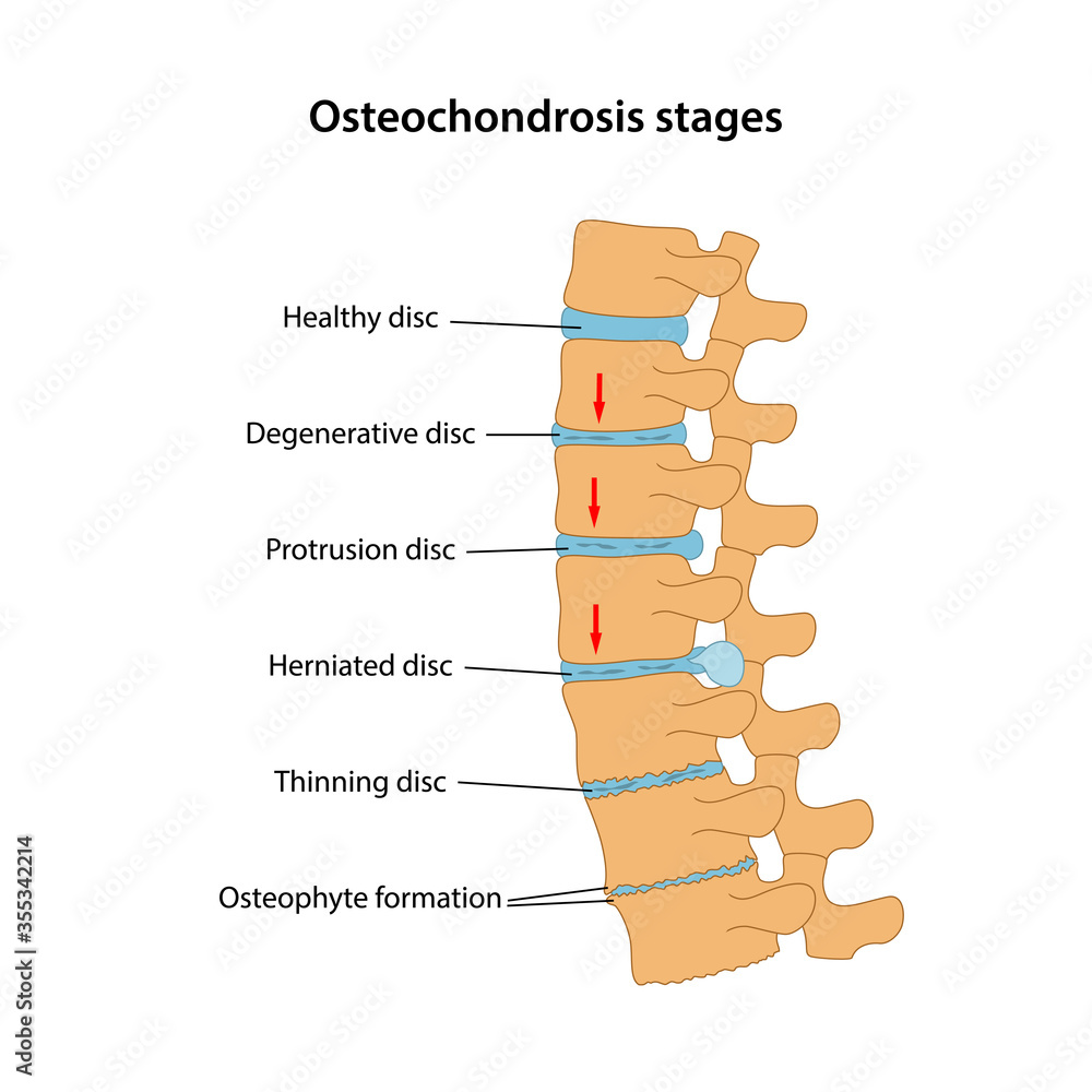 Wall mural stages of spinal osteochondrosis with main description: healthy disc, degenerative disc, protrusion,