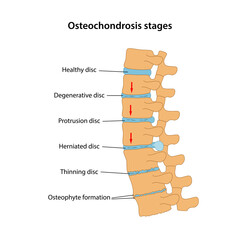 Stages of spinal osteochondrosis with main description: healthy disc, degenerative disc, protrusion, herniated, osteophyte formation. Medical vector illustration in flat style - obrazy, fototapety, plakaty