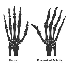 Rheumatoid arthritis of the human's hands. Black silhouettes of healthy and sore hands isolated on white background. Medical vector illustration