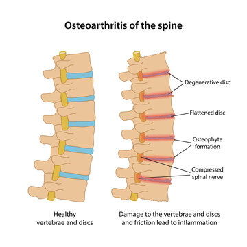 Osteoarthritis of the spine with main description. Healthy spine and spine with osteoarthritis in lateral view are isolated on white background. Vector illustration in flat style