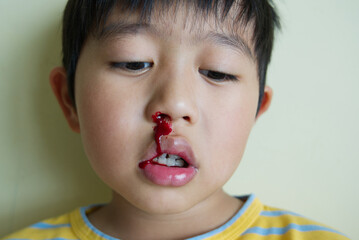 One Asian boy with a lot of blood from the nose bleeding next the plain light yellow wall background. Young kid and the small injury/accident from playing.