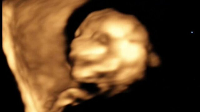 4d Ultrasound of fetus