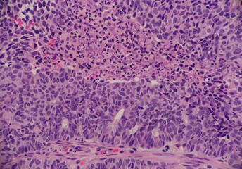 Adenocarcinoma of the endometrium with solid areas and necrosis. Microscopic view.