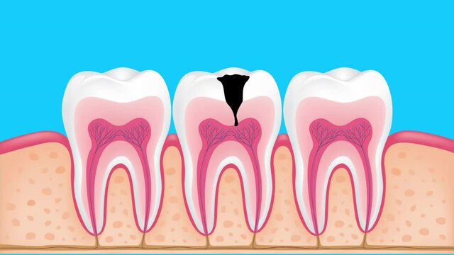 Stages of caries development. Enamel caries, Dentin caries, Pulpitis and Periodontitis. Dental care info-graphic animation.