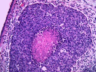 Detail of high grade urothelial carcinoma of the ureter in a man. The tumor has central necrosis...