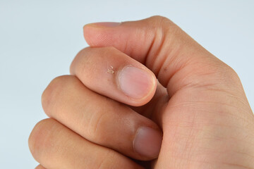 Finger with hangnail isolated on white background