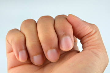Finger with hangnail isolated on white background