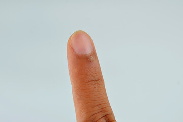 Finger with hangnail isolated on white background.