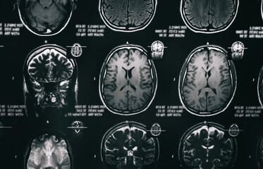 X-ray scan of the brain. Magnetic resonance head scan