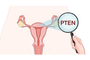 Variants in the PTEN gene are associated with an increased risk of developing uterine cancer