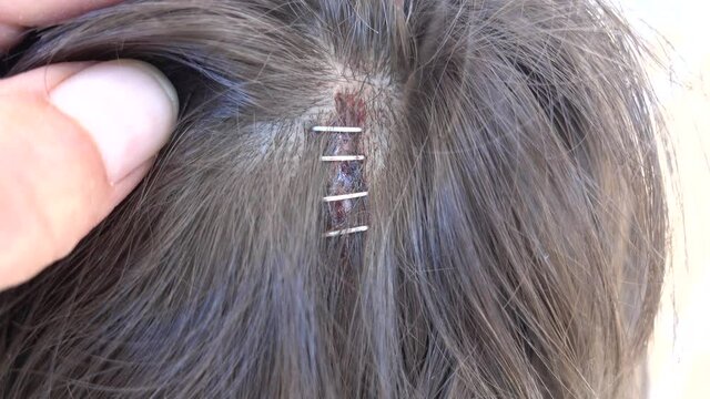 4K Healing wound after being fastened with surgical staples
