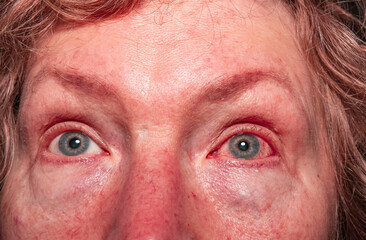 The face of a woman with severe redness and hemorrhage in the eye