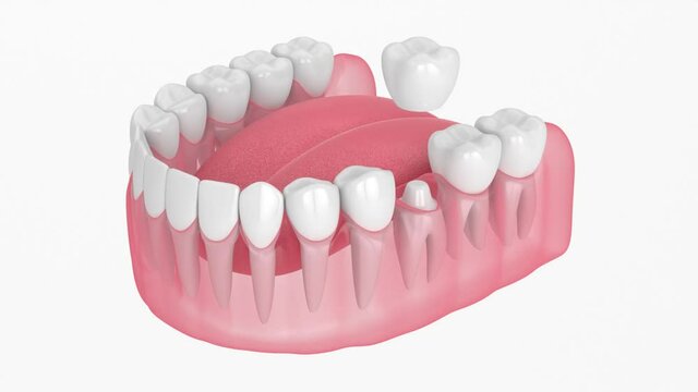 Jaw with dental crown embed on reshaped tooth over white background