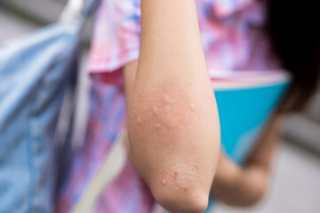 Bitten by mosquito in summer