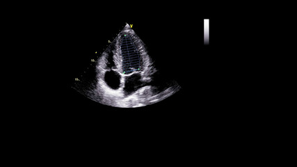 Image of the heart in gray-scale mode during transesophageal ultrasound.