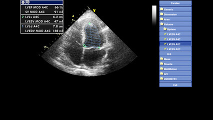 Image of the heart in gray-scale mode during transesophageal ultrasound.
