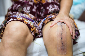 scar of knee joint replacement surgery