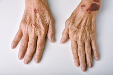 Old woman's deform hands, Skin hemorrhage bruise wound and senile purpura, Finger pain and stiffness from arthritis in senior people, Elderly healthcare concept. - obrazy, fototapety, plakaty