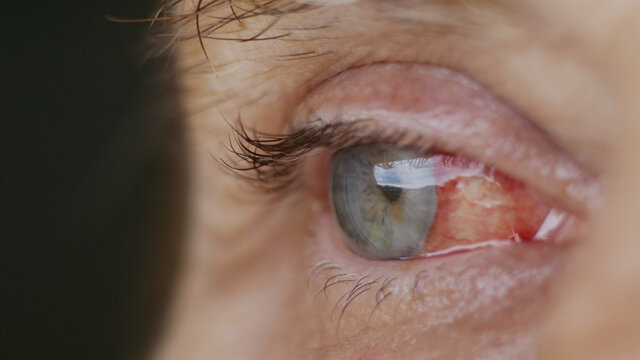 close up. woman eye with burst capillaries, cataract surgery.