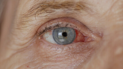 close up. elderly woman eye with burst capillaries, cataract surgery. - obrazy, fototapety, plakaty