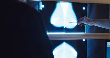 Doctor examines mammogram snapshot of breast of female patient on the monitors with magnifying...