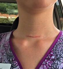 A healing scar on a woman's neck from thyroidectomy surgery due to papillary thyroid cancer 