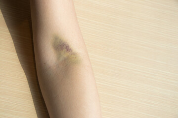 Bruise injury on the female arm background