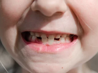 a small child's missing teeth