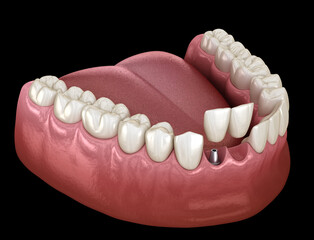 Cantilever bridge implant based, frontal tooth recovery. Medically accurate 3D animation of dental concept