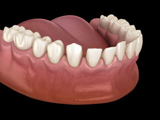 Excessive Spacing between teeth. Dental 3D illustration concept