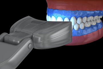 Proffesioinal teeth whitening, light-activation on tooth bleaching. 3D illustration concept.