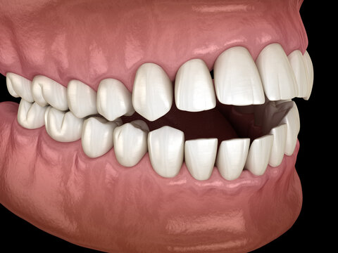 Openbite dental occlusion ( Malocclusion of teeth ). Medically accurate tooth 3D illustration