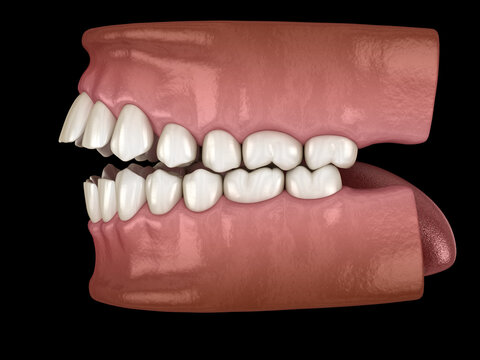 Openbite dental occlusion ( Malocclusion of teeth ). Medically accurate tooth 3D illustration