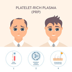Hair loss treatment by PRP therapy. Stages of platelet-rich plasma restoration procedure for men. Health care and medical concept. Vector illustration.