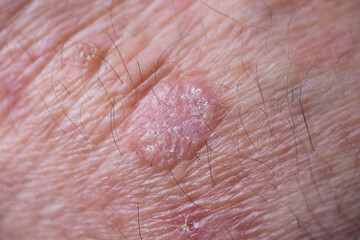 Crude eczema with redness, swellings, bumps and flakes on the wrist of a man. This can be treated...