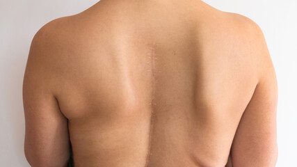 Naklejka premium Caucasian woman's upper back with a scar.