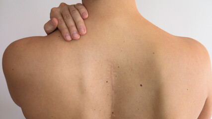 Pain in the shoulders of a woman who has a scar from spinal surgery.