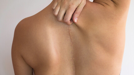 Back pain in a person who has had surgery for scoliosis.