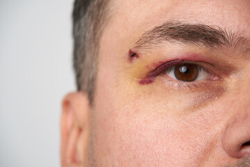 close view of a black eye, man's face with a hematoma