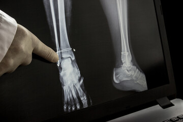 Naklejka premium X-ray after operation for the leg