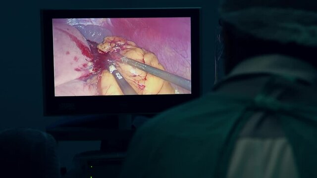 Surgeon performing laparoscopic surgery. Laparoscopic surgery on the monitor. Surgeons perform an operation and look at the screen  in the operating room. Modern technologies in medicine.