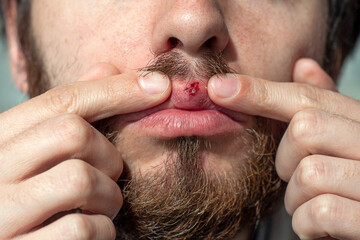 Herpes on lips of the man. Shocked man showing bleeding wound with fingers.