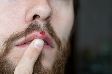 Herpes on lips of the man. Shocked man showing bleeding wound with fingers.