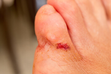 Fototapeta premium Person with a Small Bloody Cut on the Little Toe