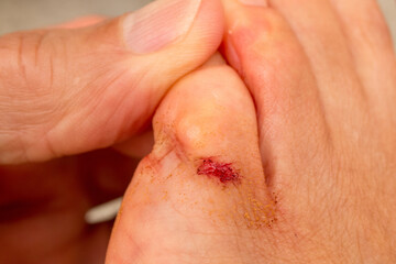 Person with a Small Bloody Cut on the Little Toe 

