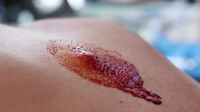 Cleaning lipoma in man's back for ambulatory surgery